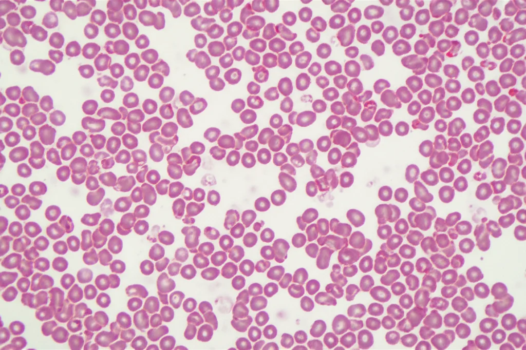 Rappresentazione microscopica ad alta definizione di cellule leucemiche nel midollo osseo, alcune evidenziate in rosso per mostrare la presenza della mutazione KIT. Illuminazione da laboratorio controllata, obiettivo macro 90mm, messa a fuoco precisa sui dettagli cellulari, sfondo leggermente sfocato.