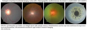 Immagine composita di multimodal imaging oculare (OCT, fluorangiografia, autofluorescenza) che mostra le caratteristiche lesioni della maculopatia placoide persistente in diversi stadi e presentazioni. Obiettivo grandangolare per fundus, con dettagli macro sulla macula, illuminazione specifica per ogni tecnica di imaging, alta risoluzione.