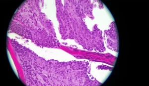 Immagine scientifica stilizzata che illustra le anomalie microvascolari nel contesto della dermatomiosite, con un focus sui capillari del letto ungueale osservati al microscopio, e la potenziale associazione con patologie neoplastiche. Macro lens, 80mm, illuminazione da studio per evidenziare i dettagli dei vasi sanguigni, alcuni dei quali appaiono dilatati o con microemorragie.