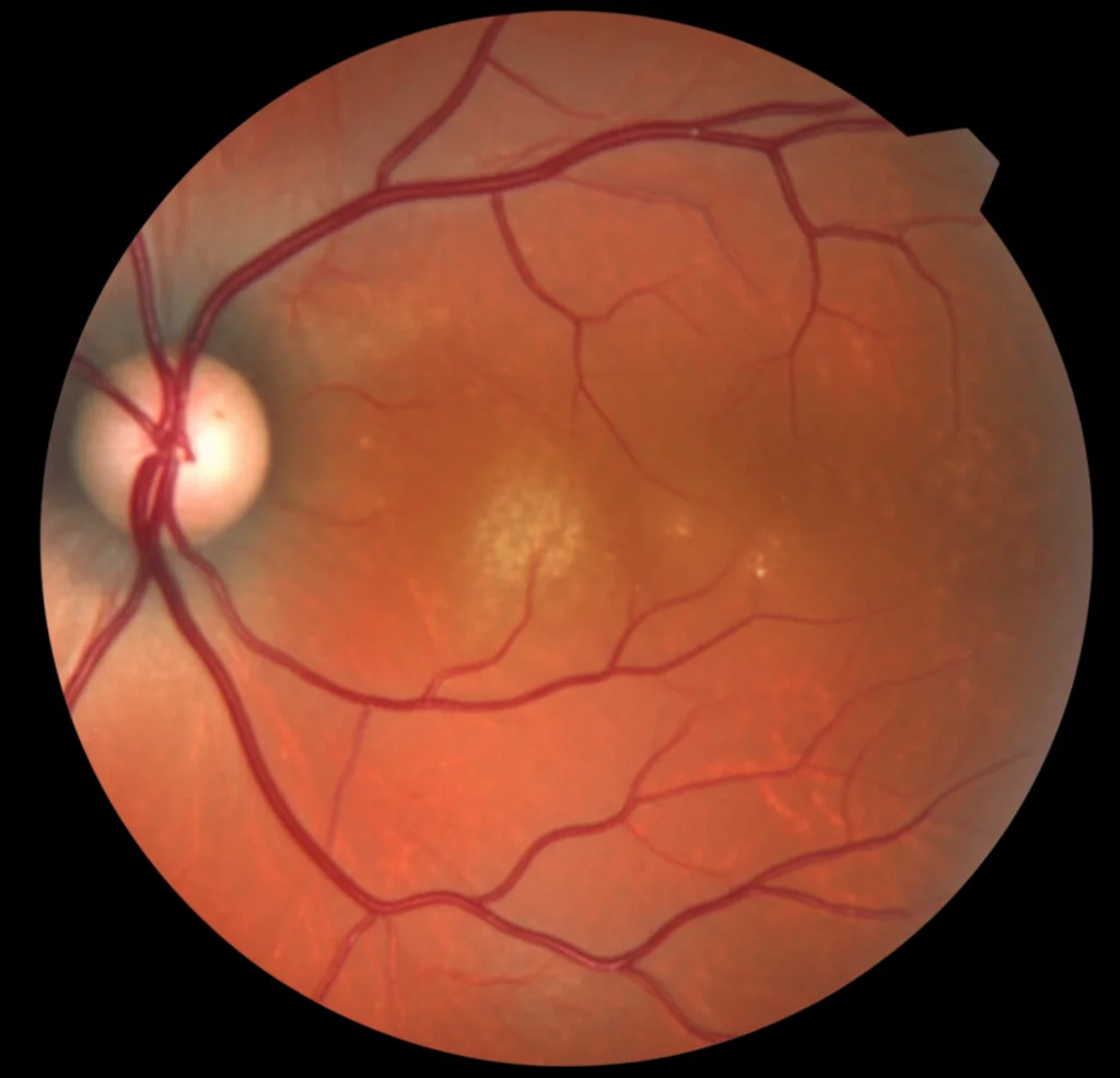 Immagine fotorealistica di un fondo oculare umano visualizzato con imaging multimodale, che mostra le caratteristiche lesioni a forma di petalo o cuneo tipiche della Neuroretinopatia Maculare Acuta (AMN) post-COVID. Si notano alterazioni della vascolarizzazione retinica. Obiettivo macro, 90mm, alta definizione, illuminazione controllata per evidenziare i dettagli patologici della macula.
