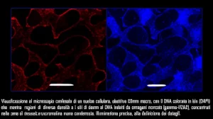 Visualizzazione al microscopio confocale di un nucleo cellulare, obiettivo 60mm macro, con il DNA colorato in blu (DAPI) che mostra regioni di diversa densità e i siti di danno al DNA indotti da oncogeni marcati in rosso (gamma-H2AX), concentrati nelle zone di eucromatina meno condensata. Illuminazione precisa, alta definizione dei dettagli.