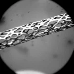 Immagine macro ad alta definizione, con lente da 100mm, di un segmento di arteria coronaria con uno stent metallico parzialmente visibile. Il focus è sul bordo dello stent dove si nota un'evidente restenosi, con tessuto iperplasico che occlude parzialmente il lume. Illuminazione da studio controllata per evidenziare la texture della placca e i dettagli dello stent. Profondità di campo ridotta per enfatizzare la zona critica.