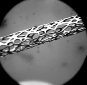 Immagine macro ad alta definizione, con lente da 100mm, di un segmento di arteria coronaria con uno stent metallico parzialmente visibile. Il focus è sul bordo dello stent dove si nota un'evidente restenosi, con tessuto iperplasico che occlude parzialmente il lume. Illuminazione da studio controllata per evidenziare la texture della placca e i dettagli dello stent. Profondità di campo ridotta per enfatizzare la zona critica.