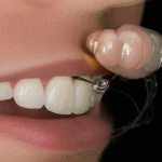 Primo piano di un innovativo risonatore indossabile per la dosimetria dentale EPR, applicato delicatamente su un incisivo. L'immagine, scattata con un obiettivo macro da 90mm, mostra i dettagli high-tech del dispositivo e la sua perfetta aderenza. Illuminazione da laboratorio controllata, focus preciso sulla superficie del dente e sul risonatore.