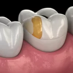Macro lens view, 60mm focal length, high detail, precise focusing, controlled lighting, showing a digital 3D model of a prepared tooth with different colored sections representing the amount of removed substance.