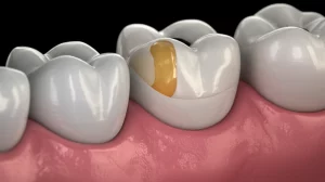 Macro lens view, 60mm focal length, high detail, precise focusing, controlled lighting, showing a digital 3D model of a prepared tooth with different colored sections representing the amount of removed substance.