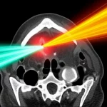 Immagine fotorealistica ad alta definizione di un fascio di radiazioni stilizzato che colpisce con precisione un'area target nel rinofaringe su un'immagine TC, simboleggiando la radioterapia adattiva guidata dall'IA, obiettivo macro 100mm, illuminazione drammatica.