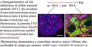 Immagine macro ad alta definizione di cellule tumorali epatiche (HCC) che invadono aggressivamente il tessuto circostante sano. In primo piano, dettagli molecolari evidenziati con fluorescenza: la proteina FTO appare ridotta (colore debole/blu) mentre le modificazioni m6A sull'RNA sono abbondanti (punti luminosi/rossi). Illuminazione drammatica e controllata, obiettivo macro 100mm, alta profondità di campo per mostrare l'invasione.