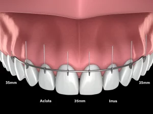 Digital 3D rendering of a dental arch with measurement callouts, prime lens, 35mm, depth of field, illustrating orthodontic space analysis for incisor alignment.