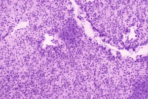 Immagine al microscopio di cellule tumorali ameloblastiche sinonasali con evidenziazione grafica di una mutazione del gene BRAF, alta definizione, illuminazione da laboratorio, obiettivo macro 100mm, colori a contrasto per dettaglio scientifico.