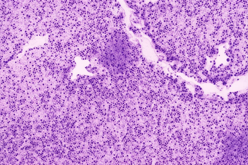 Immagine al microscopio di cellule tumorali ameloblastiche sinonasali con evidenziazione grafica di una mutazione del gene BRAF, alta definizione, illuminazione da laboratorio, obiettivo macro 100mm, colori a contrasto per dettaglio scientifico.