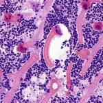 Immagine macro ad alta definizione di cellule tumorali ossee GCTB al microscopio, illuminazione controllata, focus preciso su cellule giganti multinucleate e cellule stromali mononucleate positive per H3.3 G34W, obiettivo macro 100mm.