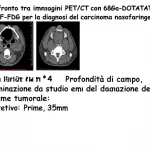 Confronto tra immagini PET/CT con 68Ga-DOTATATE e 18F-FDG per la diagnosi del carcinoma nasofaringeo, evidenziando la precisione nella delineazione del volume tumorale. Obiettivo: Prime, 35mm. Dettagli: Profondità di campo, illuminazione da studio, focus sui dettagli delle scansioni.