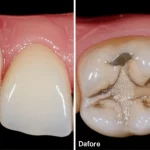 Un'immagine composita che mostra a sinistra un molare con MIH prima del trattamento e a destra lo stesso molare dopo un restauro con cemento vetroionomero rinforzato con zirconia, evidenziando il miglioramento estetico e funzionale. Illuminazione da studio, obiettivo macro 60mm, alta definizione.