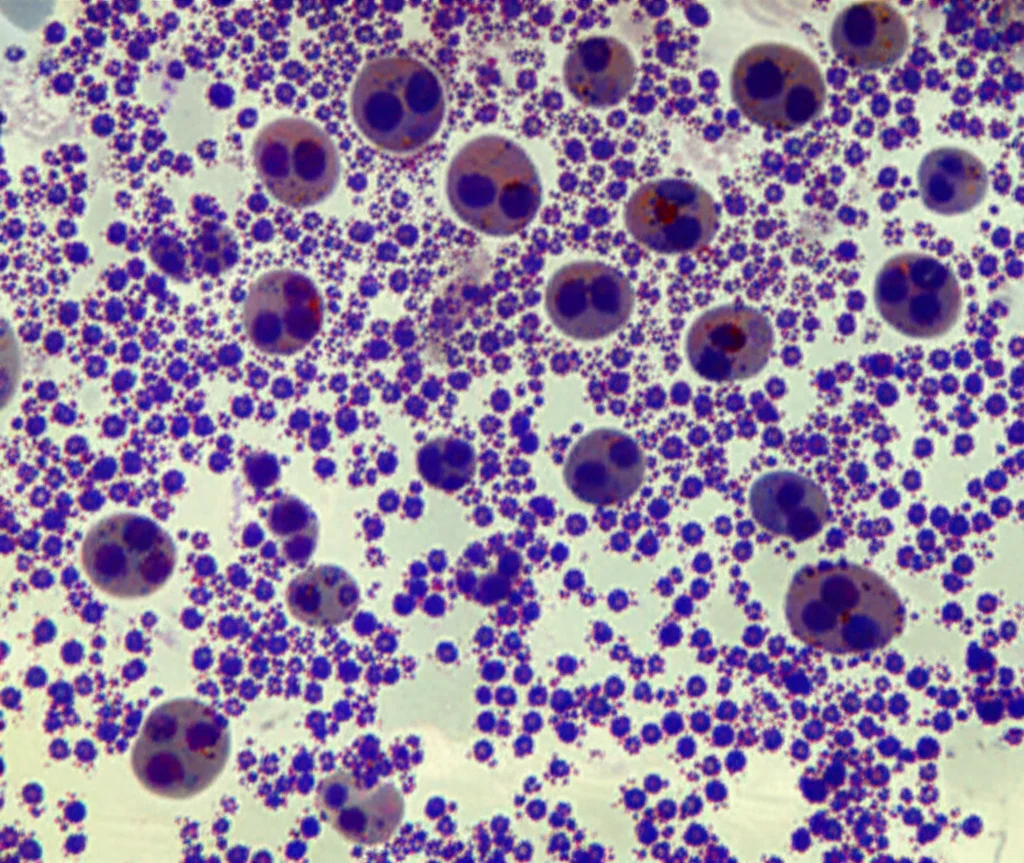 Un'immagine macro, con lente da 90mm, di cellule immunitarie (linfociti T CD8+ dai colori vivaci e cellule NK) che attaccano cellule tumorali del cancro al seno (più grandi e scure) in un microambiente infiammato, con alcune cellule MDSC (di colore neutro, quasi mimetizzate) che cercano di interferire. Illuminazione controllata per evidenziare i dettagli cellulari, alta definizione, focus preciso sulle interazioni cellulari.