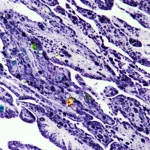 Fotografia macro ad altissima risoluzione di una sezione di tessuto tumorale testa-collo con una struttura linfoide terziaria matura (mTLS) chiaramente visibile. L'immagine, ottenuta con tecnica di immunoistochimica multiplex, mostra cellule B (CD20+) aggregate in un centro germinativo, circondate da cellule T CD4+ e CD8+, e cellule dendritiche (DC-LAMP+). Illuminazione da studio controllata per massimo dettaglio e contrasto cromatico. Obiettivo macro 105mm, profondità di campo ridotta per focalizzare sulla mTLS.
