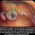 Visualizzazione in realtà aumentata durante un intervento di prostatectomia robot-assistita, con un modello 3D dettagliato della prostata e dei fasci neurovascolari sovrapposto all'immagine endoscopica live. Obiettivo macro, 80mm, alta definizione, illuminazione chirurgica precisa, profondità di campo per evidenziare la sovrapposizione AR.