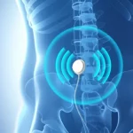 Immagine concettuale fotorealistica che mostra onde di energia stilizzate blu emanate da un piccolo dispositivo di neuromodulazione impiantato vicino al plesso sacrale umano, visibile in trasparenza. Le onde simboleggiano il ripristino della funzione nervosa e il controllo intestinale, portando a un miglioramento della qualità della vita. Sfondo astratto con colori tenui e rassicuranti (blu, bianco), focus sull'interazione armoniosa tra tecnologia medica avanzata e corpo umano. High detail, controlled lighting, precise focusing.