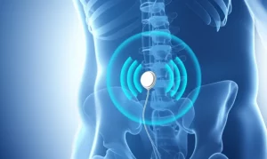 Immagine concettuale fotorealistica che mostra onde di energia stilizzate blu emanate da un piccolo dispositivo di neuromodulazione impiantato vicino al plesso sacrale umano, visibile in trasparenza. Le onde simboleggiano il ripristino della funzione nervosa e il controllo intestinale, portando a un miglioramento della qualità della vita. Sfondo astratto con colori tenui e rassicuranti (blu, bianco), focus sull'interazione armoniosa tra tecnologia medica avanzata e corpo umano. High detail, controlled lighting, precise focusing.