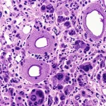 Visualizzazione microscopica di tessuto renale affetto da nefropatia diabetica, focus su glomeruli e cellule immunitarie infiltrate, illuminazione controllata, lente macro 100mm, alta definizione.