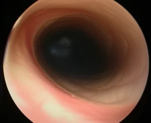 Photorealistic close-up view inside a human airway during bronchoscopy, macro lens, 60mm, high detail, showing a narrowed section.