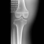Radiografia post-operatoria di una frattura del femore distale trattata con doppia placca, focus sulla placca mediale e laterale in posizione, immagine medica ad alta definizione, illuminazione controllata, obiettivo macro 100mm per dettaglio osseo.