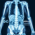 Immagine concettuale di un'analisi medica avanzata tramite intelligenza artificiale che mostra la composizione corporea da una TAC, con grafici prognostici sovrapposti. Obiettivo prime, 35mm, duotone blu e grigio, profondità di campo.