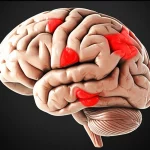 Immagine concettuale fotorealistica del cervello umano con aree evidenziate in rosso a simboleggiare il rischio di trasformazione emorragica dopo un ictus ischemico, vista dettagliata con obiettivo macro 90mm, illuminazione laterale drammatica per enfatizzare le texture.