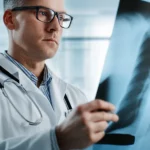 Un medico in camice bianco esamina attentamente una radiografia polmonare illuminata, in un ambiente ospedaliero moderno e luminoso. L'immagine è un ritratto fotografico con obiettivo da 35mm, con una leggera profondità di campo per mettere a fuoco il medico e la lastra, utilizzando toni di colore blu e bianco per un'atmosfera clinica ma speranzosa.