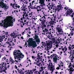 Visualizzazione microscopica ad alta definizione di cellule di melanoma maligno anorettale, obiettivo macro 100mm, con dettagli precisi sulle cellule atipiche pigmentate e non pigmentate, illuminazione controllata per evidenziare la morfologia nucleare e citoplasmatica.