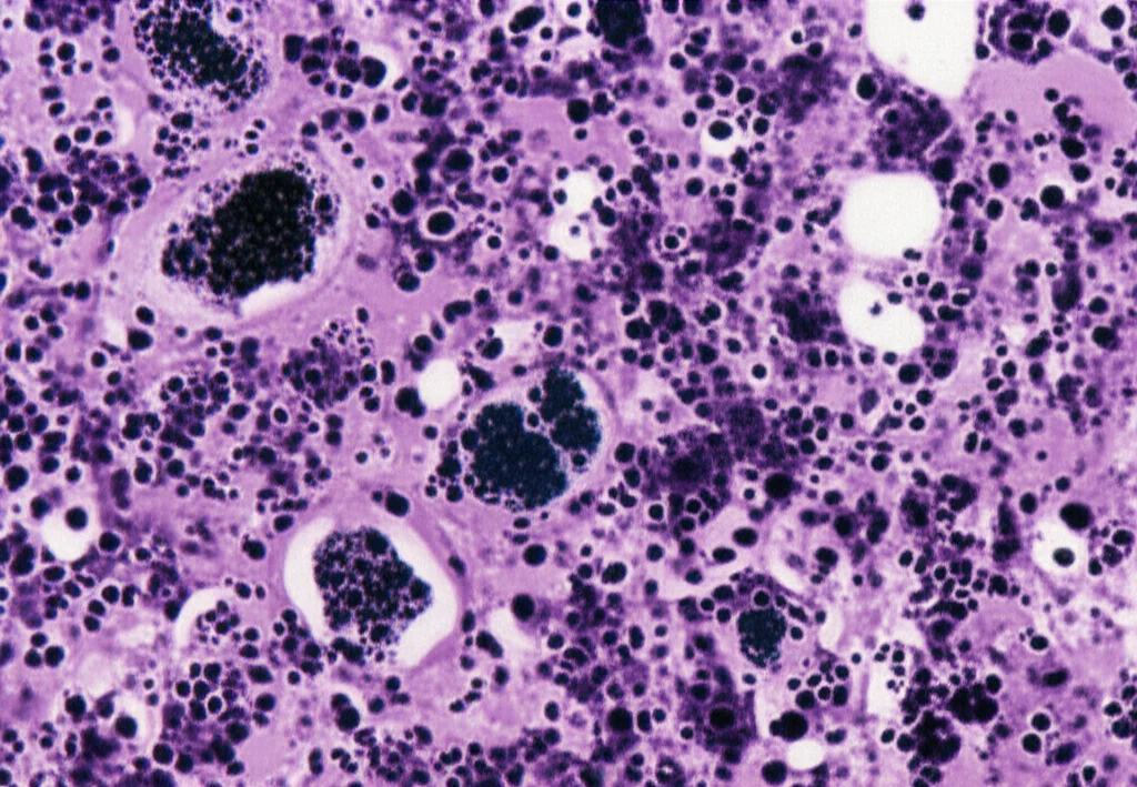 Visualizzazione microscopica ad alta definizione di cellule di melanoma maligno anorettale, obiettivo macro 100mm, con dettagli precisi sulle cellule atipiche pigmentate e non pigmentate, illuminazione controllata per evidenziare la morfologia nucleare e citoplasmatica.