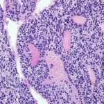 Immagine al microscopio di un glioma ad alto grado con caratteristiche pleomorfiche e pseudopapillari (HPAP), evidenziando la complessità cellulare e le strutture atipiche. Obiettivo macro, focale 60mm, illuminazione da laboratorio controllata per massima nitidezza dei dettagli istologici, mostrando cellule di varie forme e dimensioni e pattern pseudopapillari.