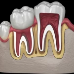 Immagine ad alto dettaglio di un modello 3D di un primo molare mandibolare con un sistema di canali radicolari a forma di C ben visibile, con particolare enfasi sulla bilateralità e sulla presenza di quattro canali separati. Obiettivo macro 90mm, illuminazione da studio per risaltare le texture e i dettagli anatomici.