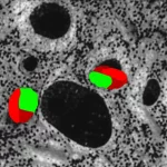 Immagine fotorealistica di cellule di adenocarcinoma gastrico al microscopio elettronico, con evidenziazione delle proteine PD-L1 (in rosso) e BATF2 (in verde) sulla membrana cellulare. Lente macro, 100mm, alta definizione, illuminazione laterale per creare profondità e dettaglio, sfondo scuro e pulito.