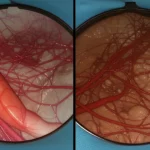 Immagine fotorealistica, obiettivo prime 35mm, che mostra una vista divisa: a sinistra una complessa rete di vasi sanguigni pancreatici (asse SMV-PV, vena splenica) come vista in laparoscopia; a destra la stessa vista ma con questi vasi chiaramente segmentati ed evidenziati in colori vivaci da una sovrapposizione AI, profondità di campo, alto dettaglio, concetto di IA che migliora la visione chirurgica.