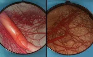 Immagine fotorealistica, obiettivo prime 35mm, che mostra una vista divisa: a sinistra una complessa rete di vasi sanguigni pancreatici (asse SMV-PV, vena splenica) come vista in laparoscopia; a destra la stessa vista ma con questi vasi chiaramente segmentati ed evidenziati in colori vivaci da una sovrapposizione AI, profondità di campo, alto dettaglio, concetto di IA che migliora la visione chirurgica.