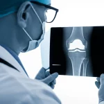 Primo piano di un chirurgo ortopedico che esamina attentamente una radiografia di un ginocchio con una protesi monocompartimentale, luce da studio, obiettivo prime 35mm, profondità di campo, bianco e nero con dominanti blu.