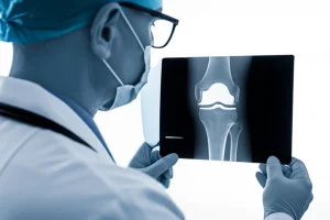 Primo piano di un chirurgo ortopedico che esamina attentamente una radiografia di un ginocchio con una protesi monocompartimentale, luce da studio, obiettivo prime 35mm, profondità di campo, bianco e nero con dominanti blu.