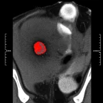Immagine medica astratta ad alta definizione che mostra una sezione trasversale di un rene umano visualizzata tramite scansione TC Dual Energy. Una piccola lesione iperdensa è evidenziata con colori brillanti (rosso/giallo) che rappresentano la concentrazione di iodio, distinguendola dal tessuto circostante. Illuminazione drammatica controllata, obiettivo macro 80mm, alta risoluzione, focus sulla lesione.