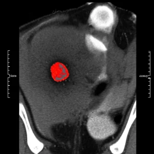 Immagine medica astratta ad alta definizione che mostra una sezione trasversale di un rene umano visualizzata tramite scansione TC Dual Energy. Una piccola lesione iperdensa è evidenziata con colori brillanti (rosso/giallo) che rappresentano la concentrazione di iodio, distinguendola dal tessuto circostante. Illuminazione drammatica controllata, obiettivo macro 80mm, alta risoluzione, focus sulla lesione.