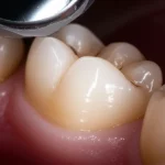 Macro lens, 60mm, high detail, precise focusing, controlled lighting, showing a close-up view of a primary molar tooth being treated.