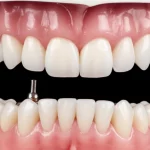 Primo piano di una protesi dentale full-arch provvisoria con barra di rinforzo in PEEK montata su un modello mascellare, illuminazione da studio per evidenziare i dettagli dei materiali e la precisione dell'adattamento, obiettivo macro 70mm, alta definizione, messa a fuoco precisa sulla giunzione barra-impianto.