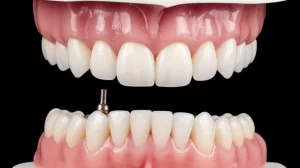 Primo piano di una protesi dentale full-arch provvisoria con barra di rinforzo in PEEK montata su un modello mascellare, illuminazione da studio per evidenziare i dettagli dei materiali e la precisione dell'adattamento, obiettivo macro 70mm, alta definizione, messa a fuoco precisa sulla giunzione barra-impianto.