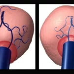 Visualizzazione medica fotorealistica di un aneurisma cerebrale prima e dopo l'intervento (clipping o endovascolare), con evidenza delle aree a rischio di infarto cerebrale correlato alla chirurgia (SRCI), alta definizione, illuminazione da studio, macro lens 100mm.