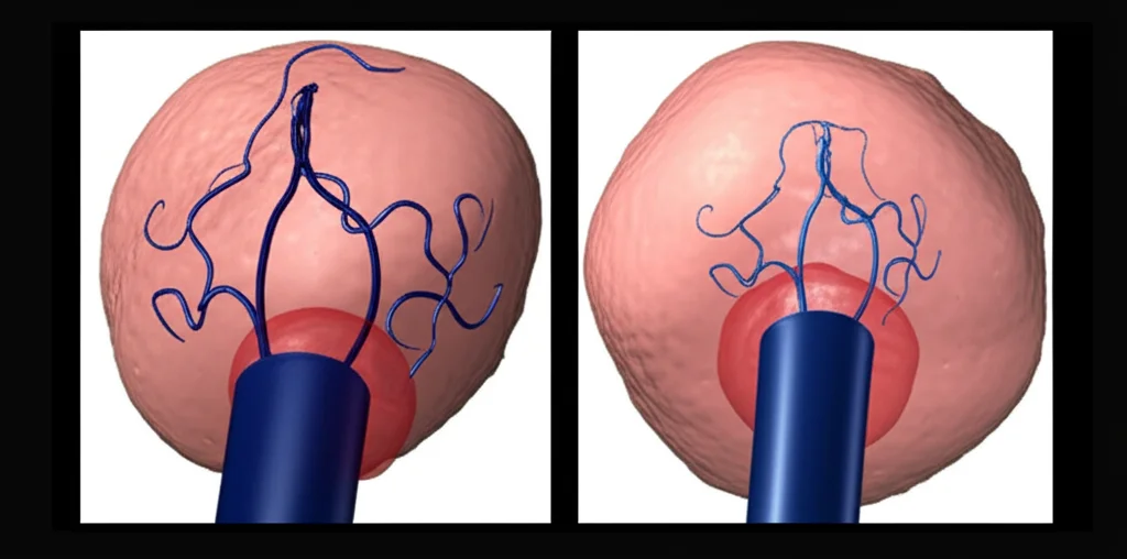 Visualizzazione medica fotorealistica di un aneurisma cerebrale prima e dopo l'intervento (clipping o endovascolare), con evidenza delle aree a rischio di infarto cerebrale correlato alla chirurgia (SRCI), alta definizione, illuminazione da studio, macro lens 100mm.