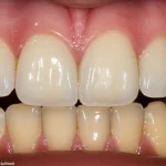 Concetto di immagine divisa: il lato sinistro mostra una linea di gomma rosa sana attorno ai denti molari dotati di un chiaro allineatore, il lato destro mostra gli stessi denti ma con una recessione di gomma moderata visibile e una leggera infiammazione, illustrando l'impatto dello stato parodontale sul trattamento dell'allineatore. Lente macro, 60 mm, dettagli elevati, illuminazione controllata.