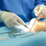 Primo piano di un chirurgo ortopedico che utilizza una guida per inserire con precisione una vite cannulata in un modello anatomico di femore durante una simulazione chirurgica, luce intensa da sala operatoria focalizzata sull'area di lavoro, strumenti chirurgici visibili, obiettivo prime 50mm, profondità di campo ridotta per enfatizzare la precisione dell'atto.