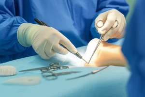 Primo piano di un chirurgo ortopedico che utilizza una guida per inserire con precisione una vite cannulata in un modello anatomico di femore durante una simulazione chirurgica, luce intensa da sala operatoria focalizzata sull'area di lavoro, strumenti chirurgici visibili, obiettivo prime 50mm, profondità di campo ridotta per enfatizzare la precisione dell'atto.