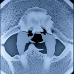 Primo piano di un'articolazione temporo-mandibolare (ATM) visualizzata tramite CBCT, con enfasi sulla precisione diagnostica e la riduzione della dose di radiazioni, obiettivo 35mm, profondità di campo per isolare l'articolazione, illuminazione da studio, toni duotone blu e grigio.