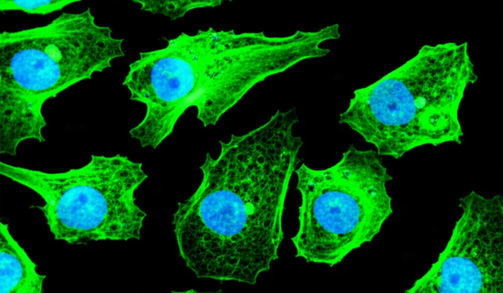 Microscopic view of lung cancer cells showing green gamma-H2AX foci indicating DNA damage, macro lens, 105mm, high detail, precise focusing, controlled lighting